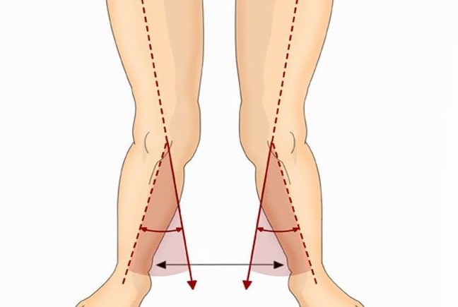 درمان زانو ضربدری (پای ضربدری) با ورزش درمانی و بریس (زانو بند) - پروفسور بیژن فروغ