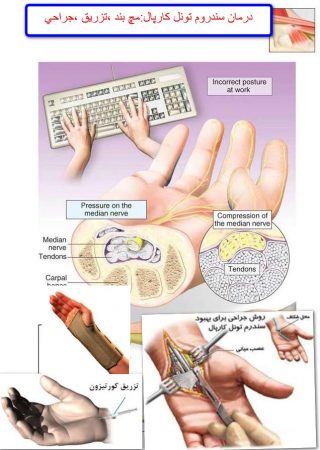 گزگز دستها سندروم تونل کارپال
