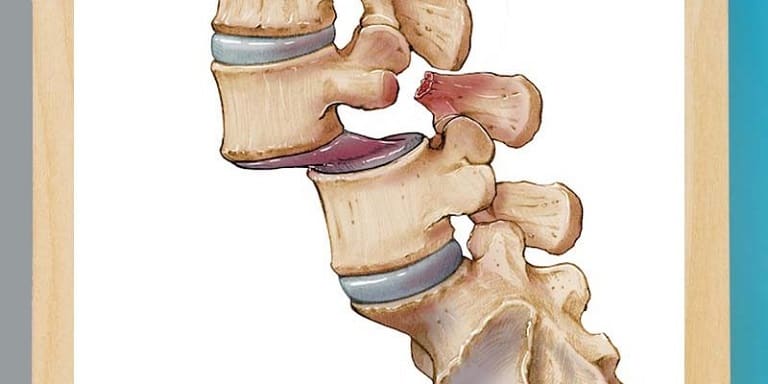 سرخوردگی-مهره-های-کمر-چیست،-علل،-درمان-ها