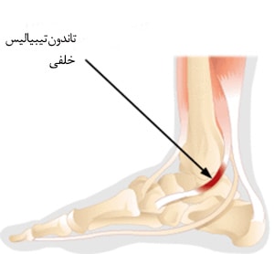 تاندونیت تیبیال خلفی