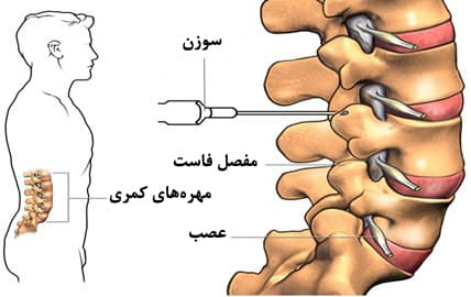 تزریق بلوک فاست و تزریق در مفصل فاست