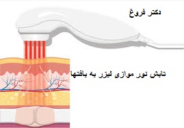 لیزر درمانی چیست؟