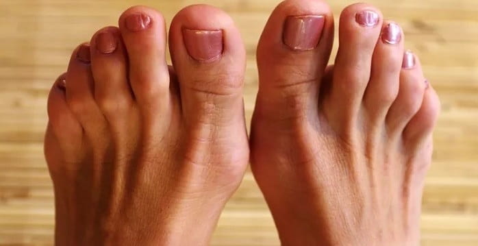 درمان انگشت چکشی در کلینیک پا