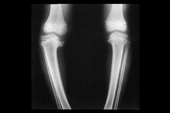 بیماری بلانت