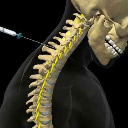 تزریق استروئید در فضای اپیدورال گردنی
